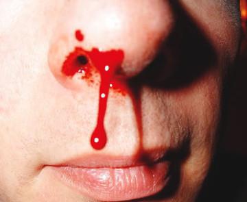 Miten veri aiheuttaa nenältä. Välitekijät