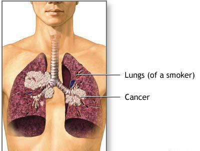 Keuhkosyöpä: kuinka monta elää? Pitääkö uskoa ennusteita?